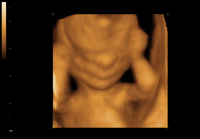 3D ultrasound image at 16 weeks